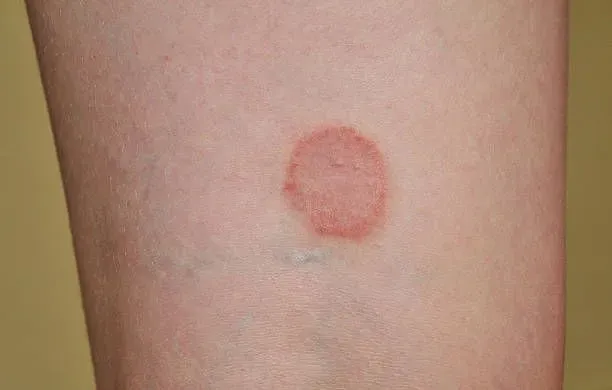 Close-up of a man's arms with red spots, suggesting a ringworm condition.