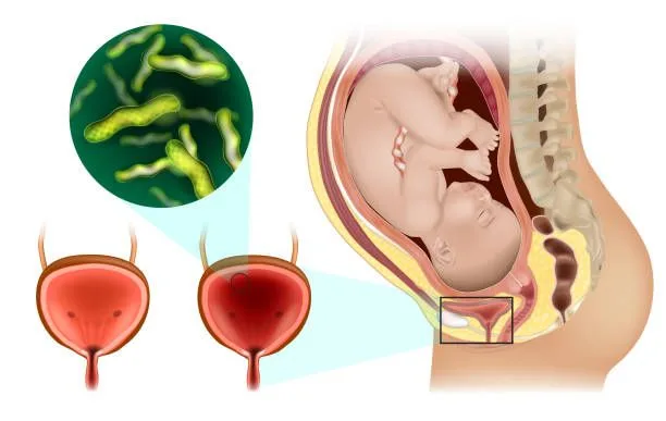 Why UTIs Are More Common in Pregnancy 