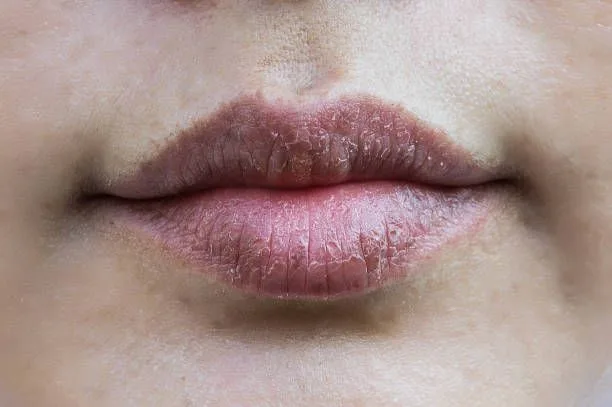 Signs You Might Be Dehydrated 