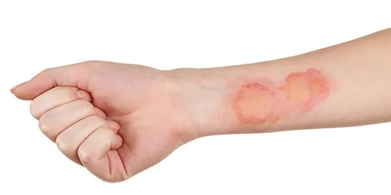 Immediate First Aid for Minor Burns and Scalds