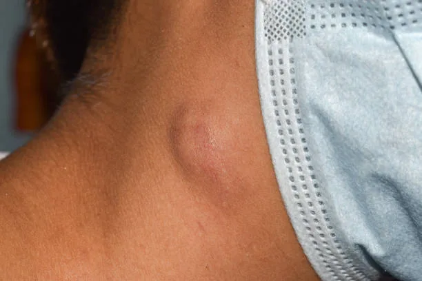 Single swelling or lymph node at the neck of a woman.
