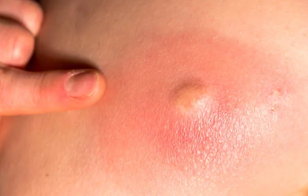 Closeup of an huge skin abcess getting more and more inflamed