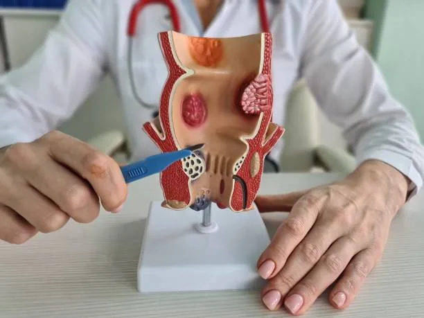 Preparation for surgery to remove hemorrhoids. Causes of constipation with hemorrhoids pain and treatment