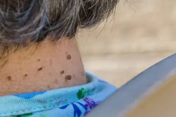 Skin tag Acrochordons