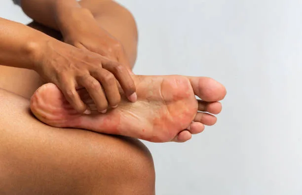 Cropped of black woman scratching her foot, suffering from fungus, grey background