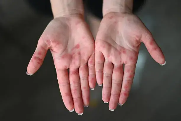 Close-up of human palms with red rash caused by Coxsackievirus, showing hand-foot-mouth disease symptoms.